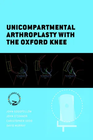 Unicompartmental Arthroplasty with the Oxford Knee