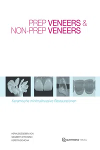 Prep Veneers und Non-Prep Veneers_cover