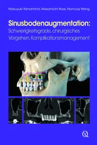 Sinusbodenaugmentation_cover