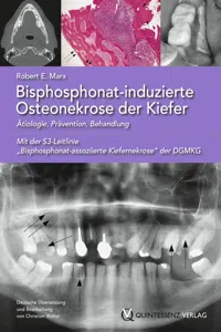 Bisphosphonat-induzierte Osteonekrose der Kiefer_cover