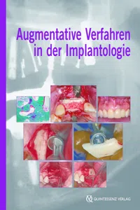 Augmentative Verfahren in der Implantologie_cover