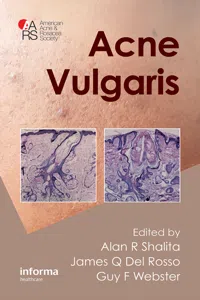 Acne Vulgaris_cover