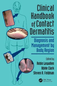 Clinical Handbook of Contact Dermatitis_cover