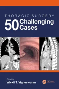 Thoracic Surgery: 50 Challenging cases_cover