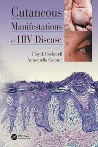 Cutaneous Manifestations of HIV Disease_cover