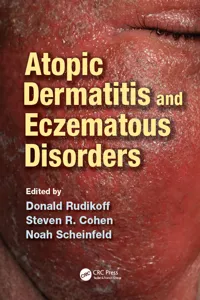 Atopic Dermatitis and Eczematous Disorders_cover