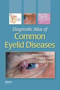 Diagnostic Atlas of Common Eyelid Diseases_cover