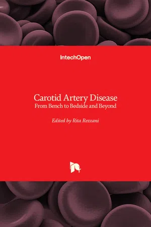 Carotid Artery Disease