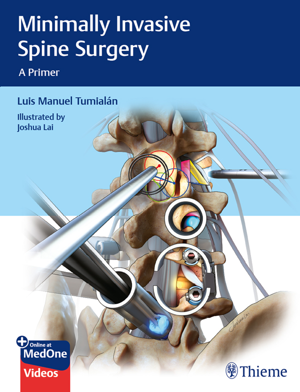 PDF] Minimally Invasive Spine Surgery by Luis Manuel Tumialan