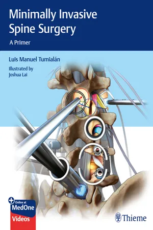 Minimally Invasive Spine Surgery