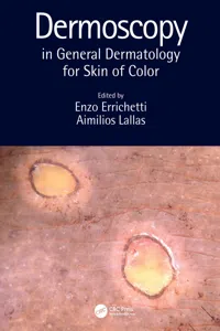 Dermoscopy in General Dermatology for Skin of Color_cover