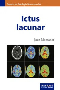 Ictus lacunar_cover