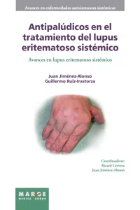 Antipalúdicos en el tratamiento del lupus eritematoso sistémico_cover