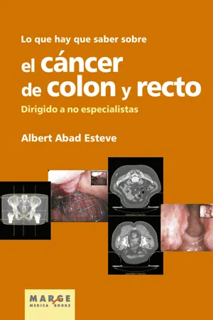 Lo que hay que saber sobre el cáncer de colon y recto