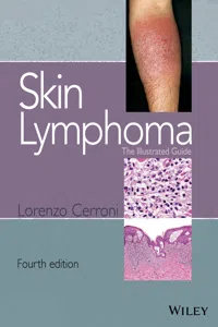 Skin Lymphoma_cover