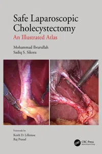 Safe Laparoscopic Cholecystectomy_cover