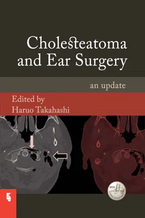 Cholesteatoma and Ear Surgery