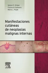 Manifestaciones cutáneas de neoplasias malignas internas_cover