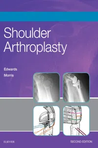 Shoulder Arthroplasty E-Book_cover