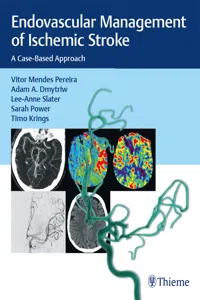 Endovascular Management of Ischemic Stroke_cover