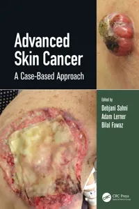 Advanced Skin Cancer_cover