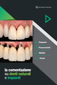 La cementazione su denti naturali e impianti_cover