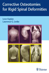 Corrective Osteotomies for Rigid Spinal Deformities_cover