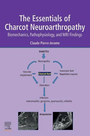 The Essentials of Charcot Neuroarthropathy