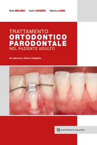 Trattamento ortodontico parodontale nel paziente adulto_cover