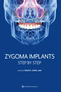 Zygoma Implants_cover