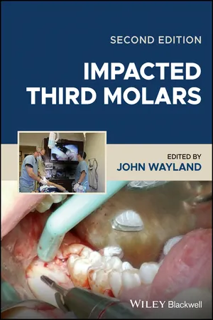 Impacted Third Molars