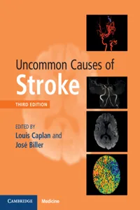 Uncommon Causes of Stroke_cover