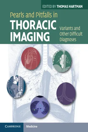 Pearls and Pitfalls in Thoracic Imaging