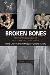 Broken Bones_cover