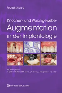 Knochen- und Weichgewebeaugmentation in der Implantologie_cover