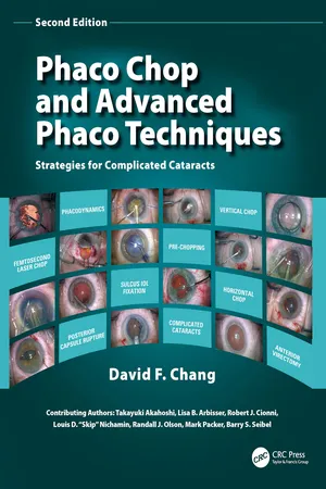 Phaco Chop and Advanced Phaco Techniques