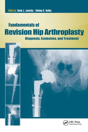 Fundamentals of Revision Hip Arthroplasty