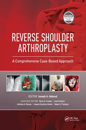 Reverse Shoulder Arthroplasty