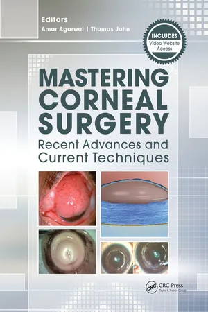 Mastering Corneal Surgery