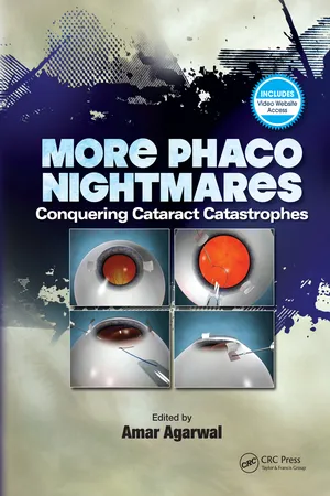 More Phaco Nightmares