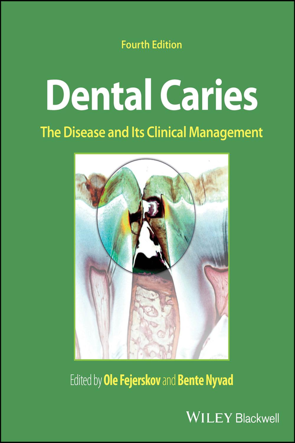 PDF] Dental Caries by Ole Fejerskov, 4th edition | 9781119679370