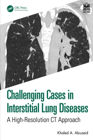 Challenging Cases in Interstitial Lung Diseases