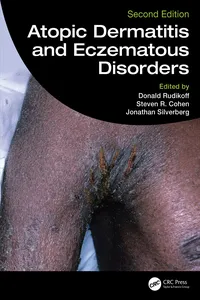 Atopic Dermatitis and Eczematous Disorders_cover