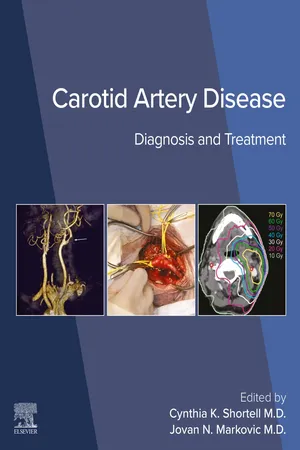 Carotid Artery Disease