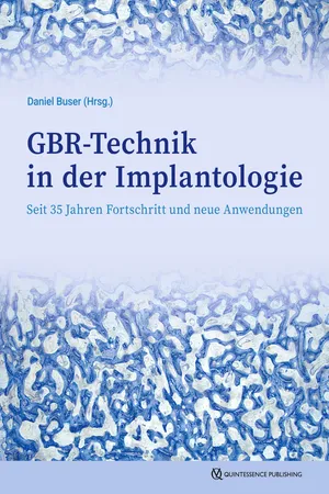 GBR-Technik in der Implantologie