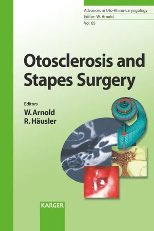 Otosclerosis and Stapes Surgery