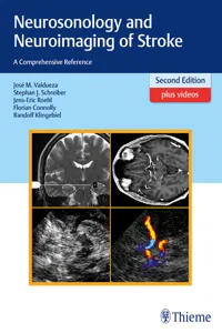 Neurosonology and Neuroimaging of Stroke_cover