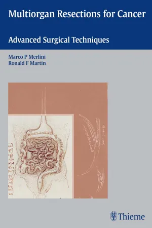 Multiorgan Resections for Cancer