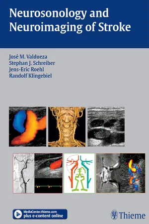 Neurosonology and Neuroimaging of Stroke