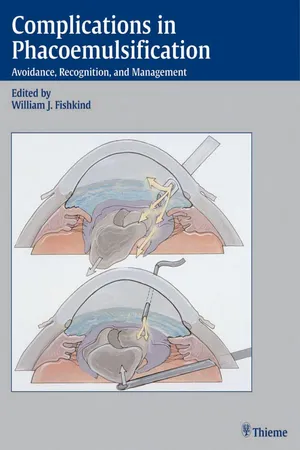 Complications in Phacoemulsification